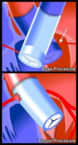 Ross & Konno Procedures